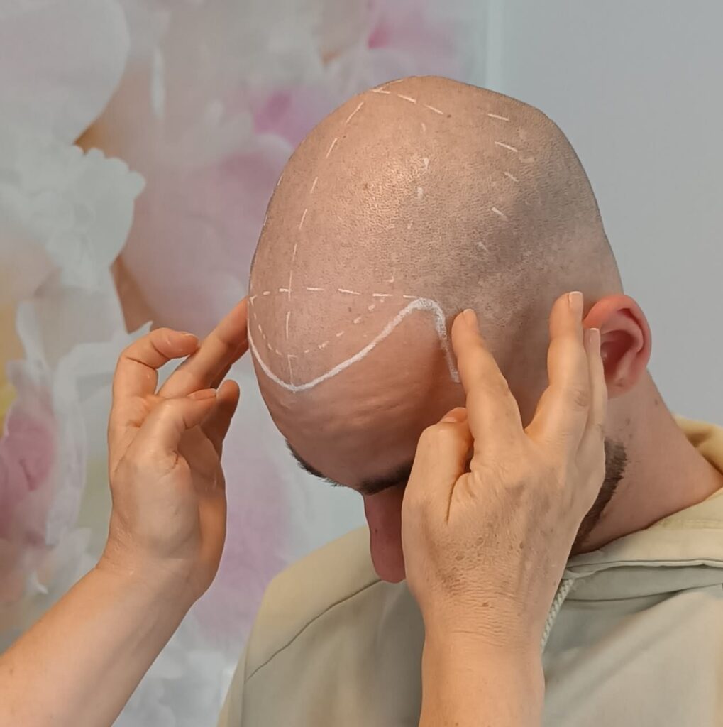 SMP Verfahren